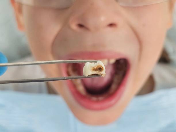 Best Emergency Tooth Extraction in Fairview, OK